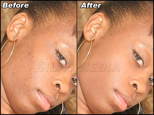 Face Clearing And Tattoo Removal